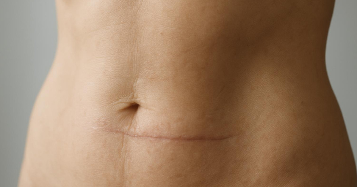 Kicsiny hegek, nagy problémák: mit okozhatnak valójában?